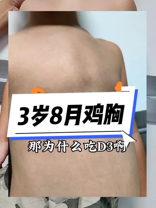 小孩子鸡胸,可能是怎么回事