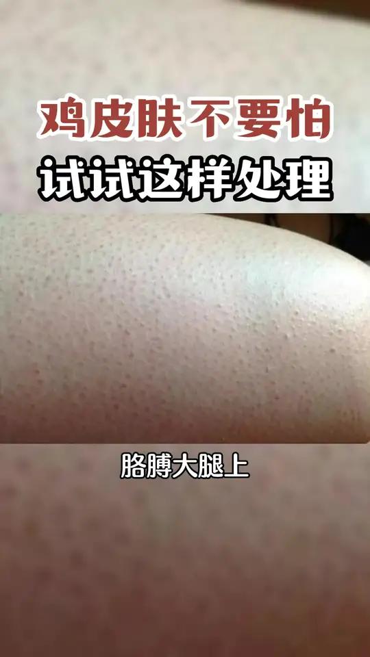 胳膊上密密麻麻的小疙瘩,鸡皮肤不好看,该怎么处理呢