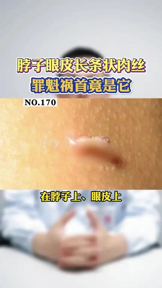 脖子眼皮长小肉丝,这种情况其实是HPV感染引起的!快照照镜子看你脖子上有没有!