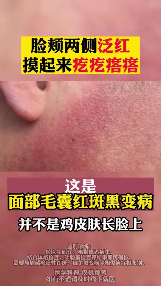 脸颊红红的摸起来疙疙瘩瘩,这可不是鸡皮肤长脸上了!