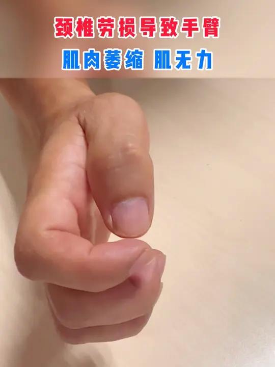 颈椎劳损后导致手臂肌肉萎缩肌无力