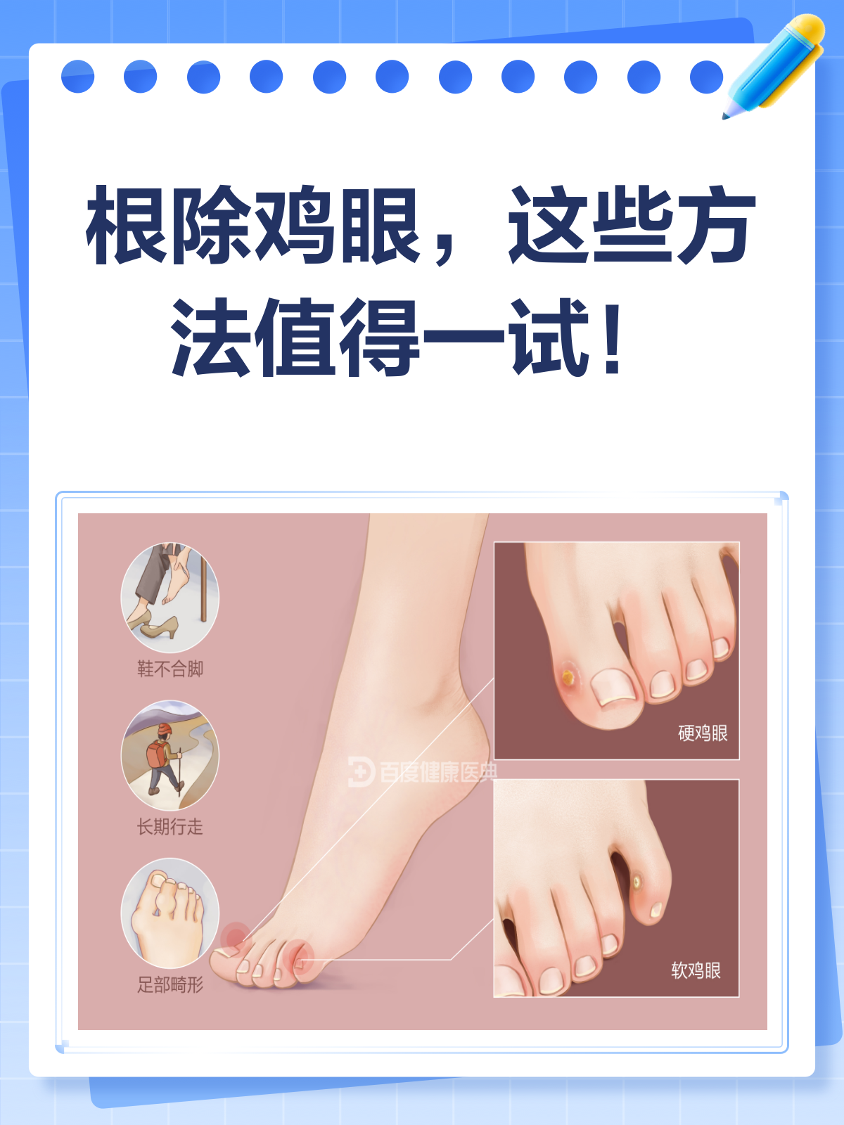 鸡眼怎么治疗能根除?全面攻略来啦!