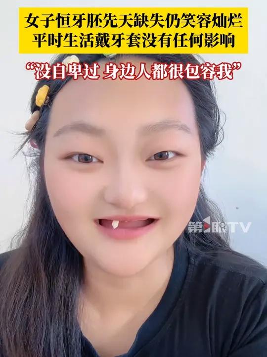 女子恒牙胚先天缺失仍笑容灿烂,平时生活戴牙套没有任何影响。当事人:没有自卑过,生活中有很多