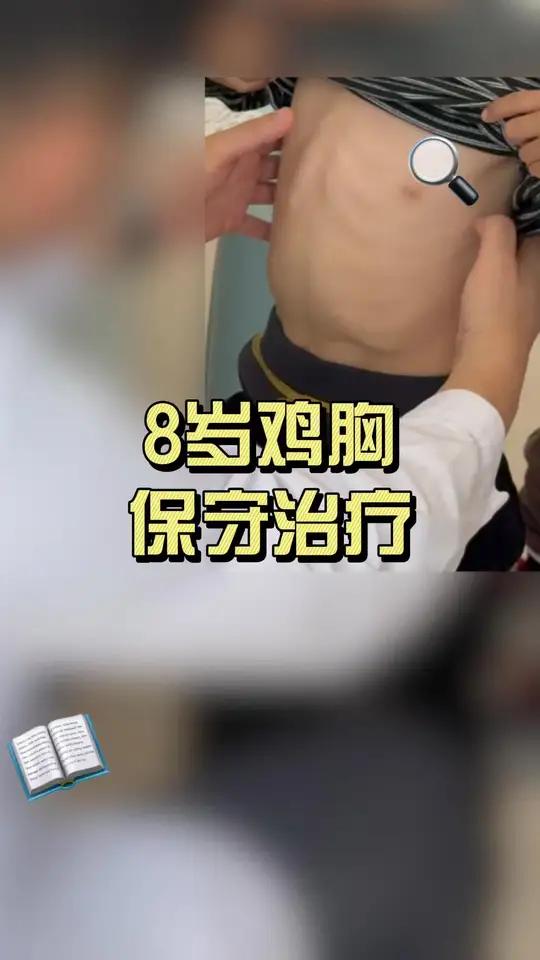 8 岁鸡胸保守治疗 #鸡胸 #漏斗胸 #肋骨外翻 #健康科普破圈计划 #抖出健康知识宝藏