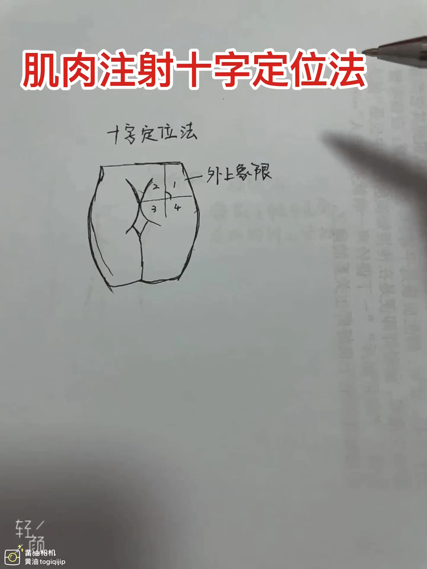 肌肉注射|十字定位法