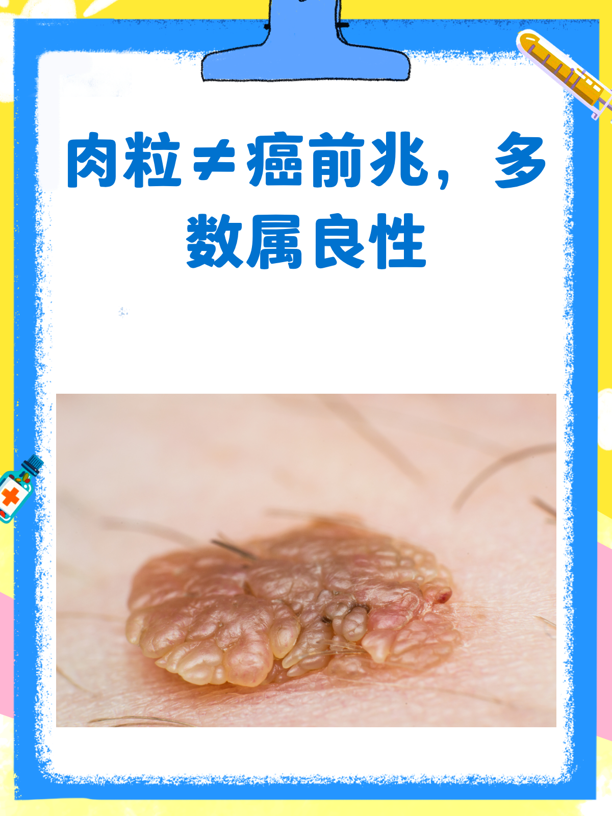 肉粒≠癌症前兆！别再自己吓自己啦