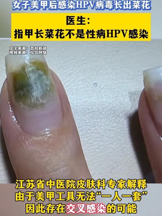 女子美甲后感染HPV病毒长出菜花,医生:指甲长菜花不是性病HPV感染