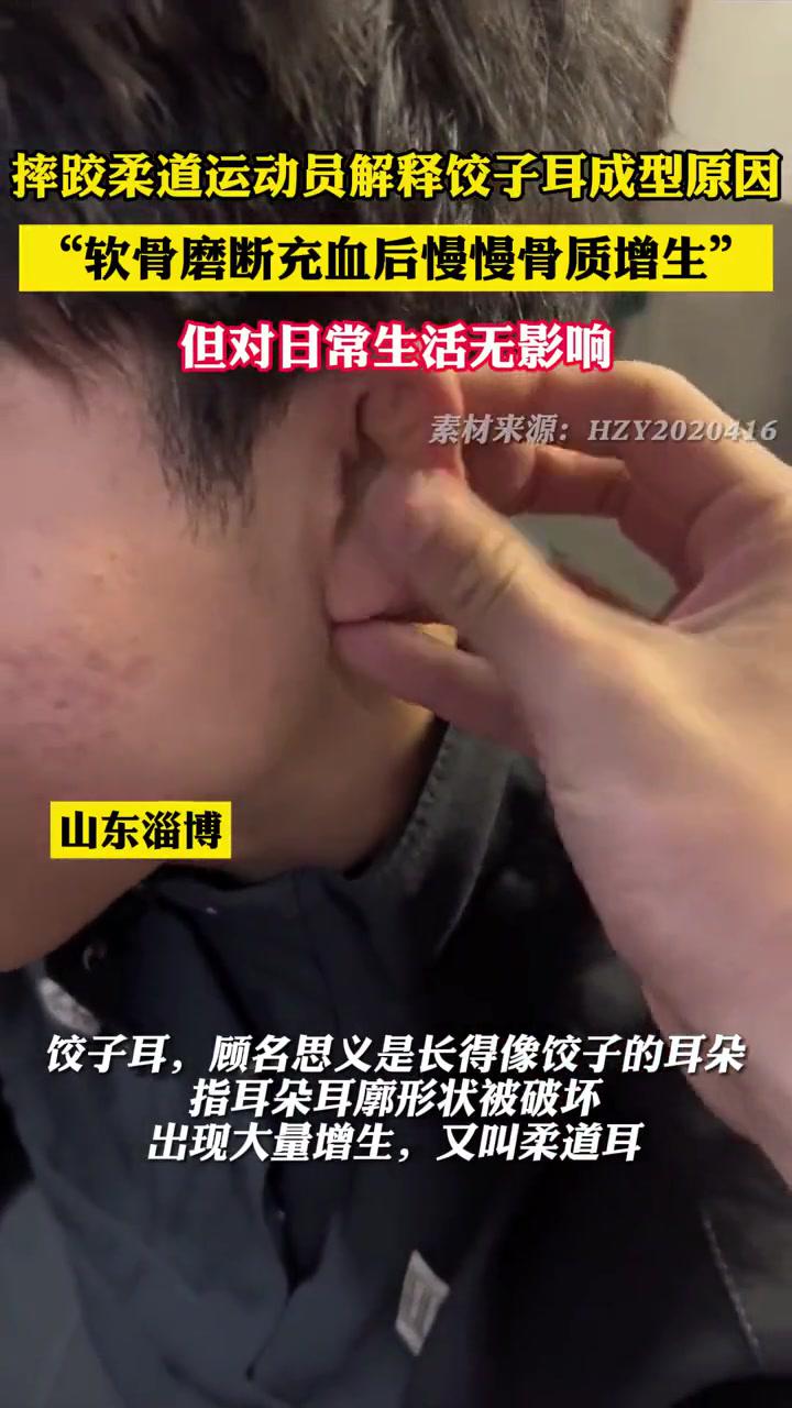摔跤柔道运动员解释饺子耳成型原因:软骨磨断充血后慢慢骨质增生