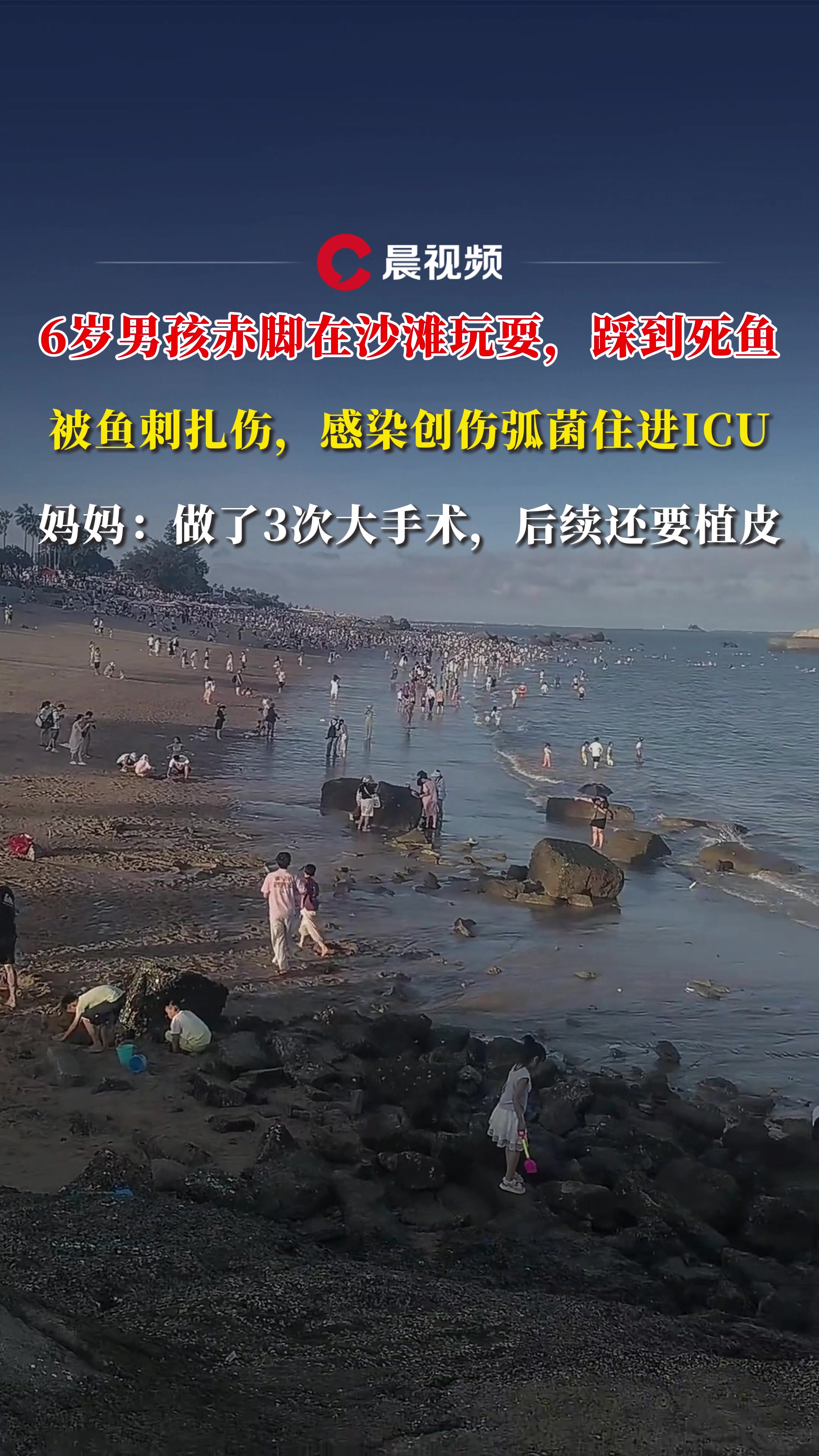 6岁男孩赤脚在沙滩踩到死鱼,被鱼刺扎伤感染创伤弧菌后住进ICU,妈妈:后续要植皮
