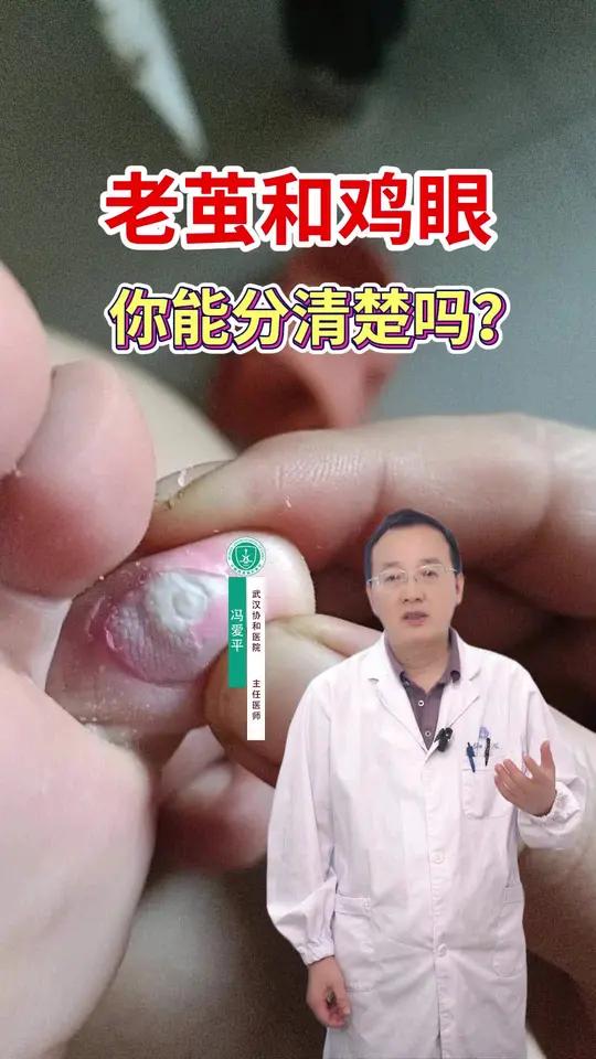 脚底硬硬的不一定是鸡眼,也可能是胼胝!