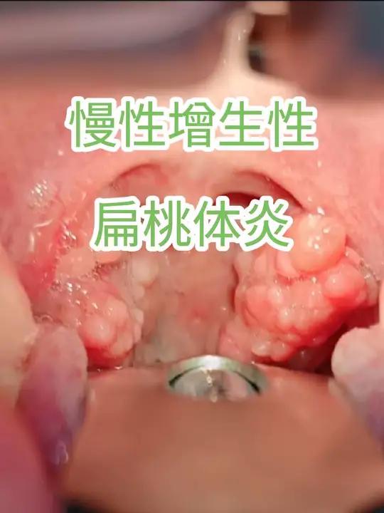 罕见疾病,慢性增生性扁桃体炎!慢性增生性扁桃体炎,很多人会被误认为乳头状瘤,大家遇到这种情