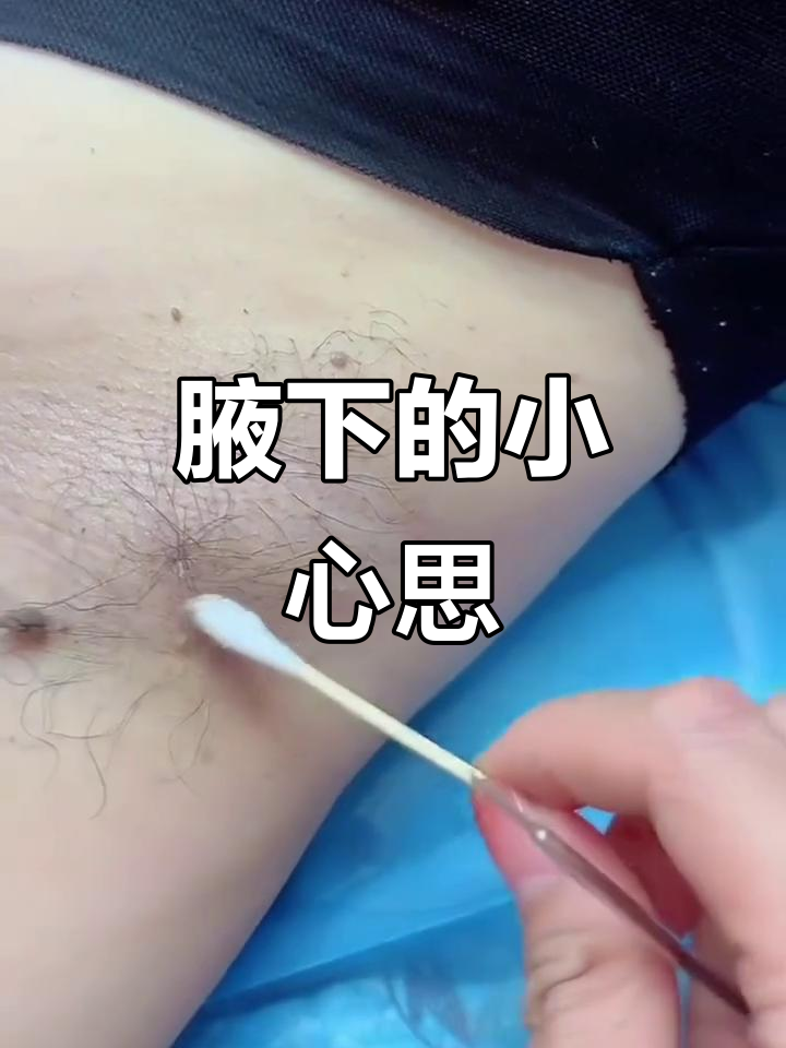 露肉季节来临,腋下小肉粒你还在忽视吗?