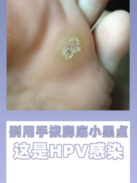 千万别用手拔里面的小黑点了,这是HPV病毒感染引起的 跖疣,医生教你正确处理不复发