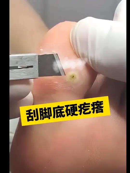 脚底板长硬疙瘩,不要瞎搞!当心是hpv感染引起的跖疣!