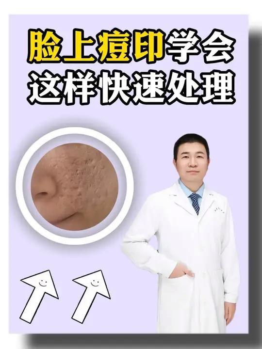 痘印比痘痘还难祛?教你这样快速处理 痘痘 痘印 痘坑 医用痤疮防疤贴