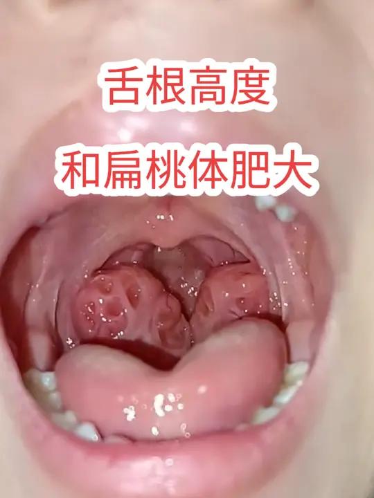 为什么有的人舌头伸老长也看不到扁桃体?为什么有的人舌头伸老长也看不到扁桃体?舌根高度决定能