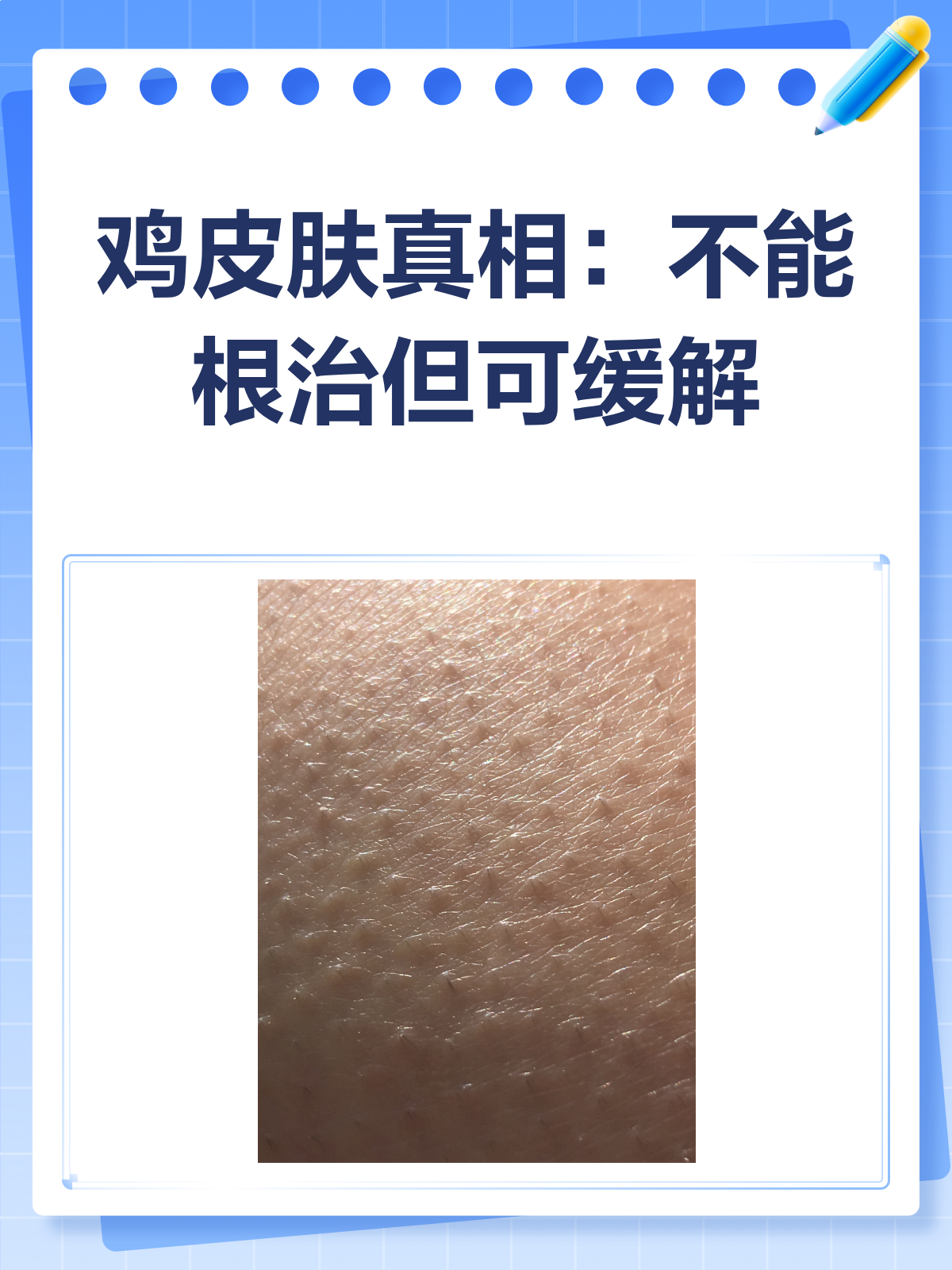 鸡皮肤真的不能根治吗?来看看真相!