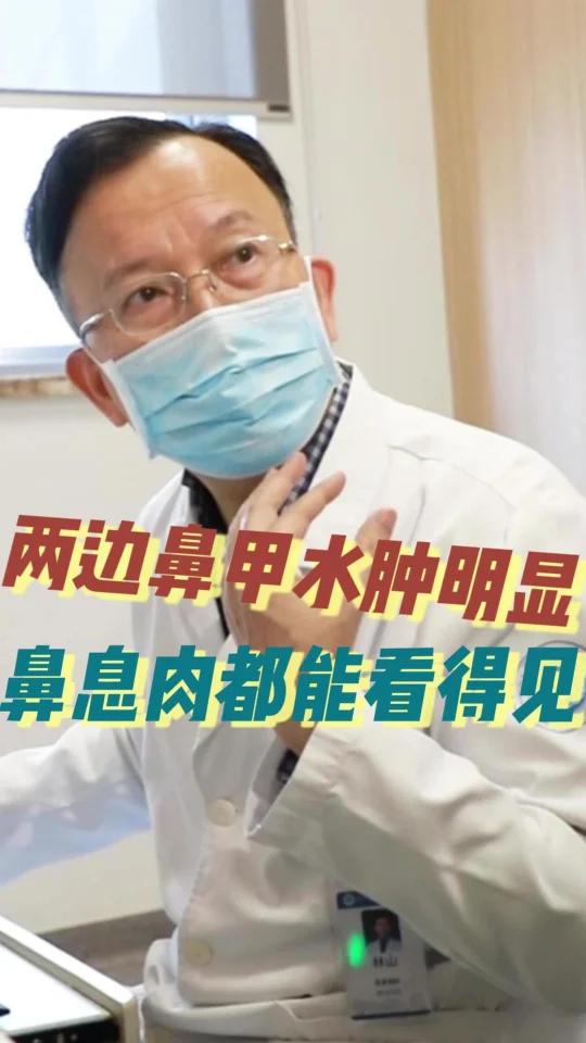 两边鼻甲水肿明显,鼻息肉都能看得见