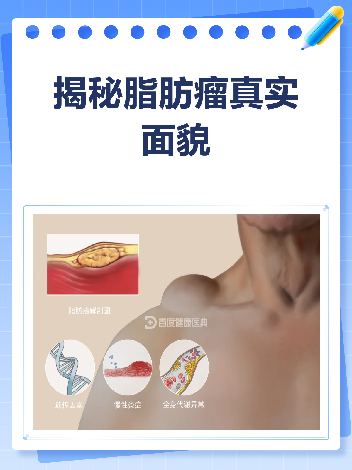 脂肪瘤VS脂肪肉瘤，你真的分得清吗？