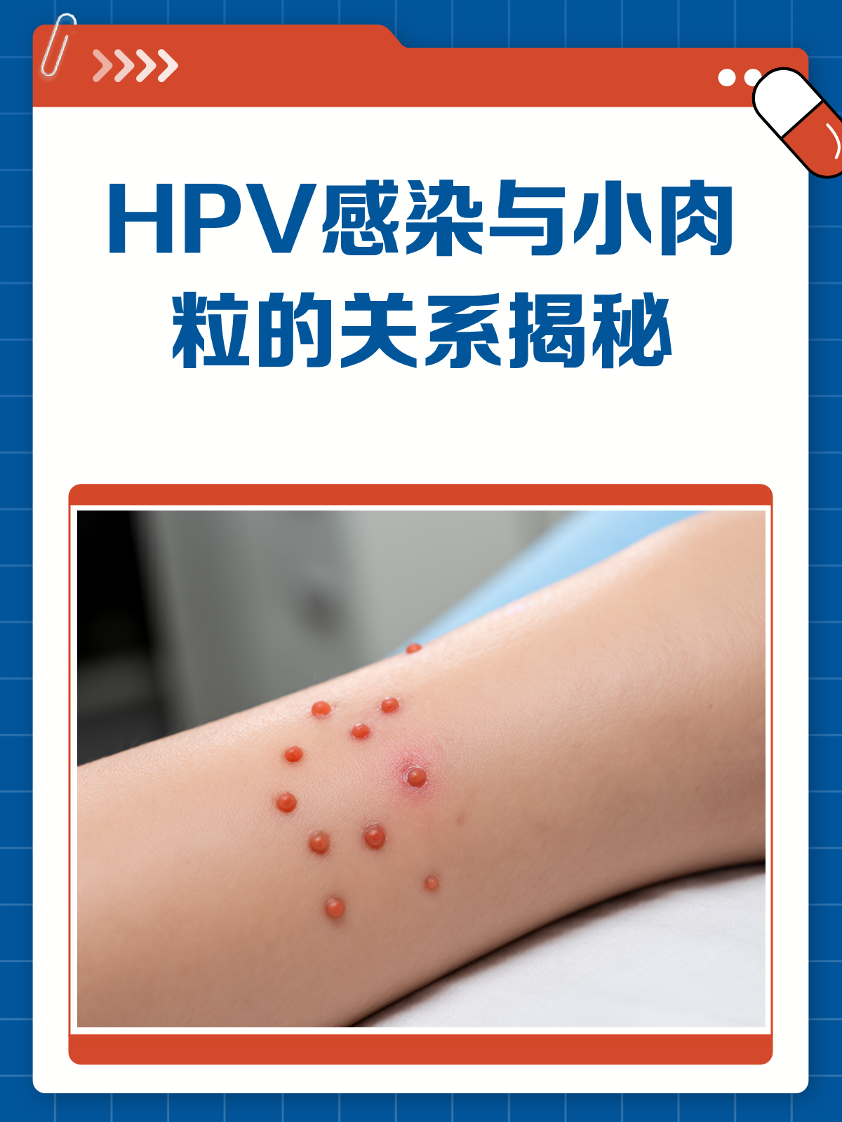 脖子和腋下长小肉粒,是HPV感染吗?