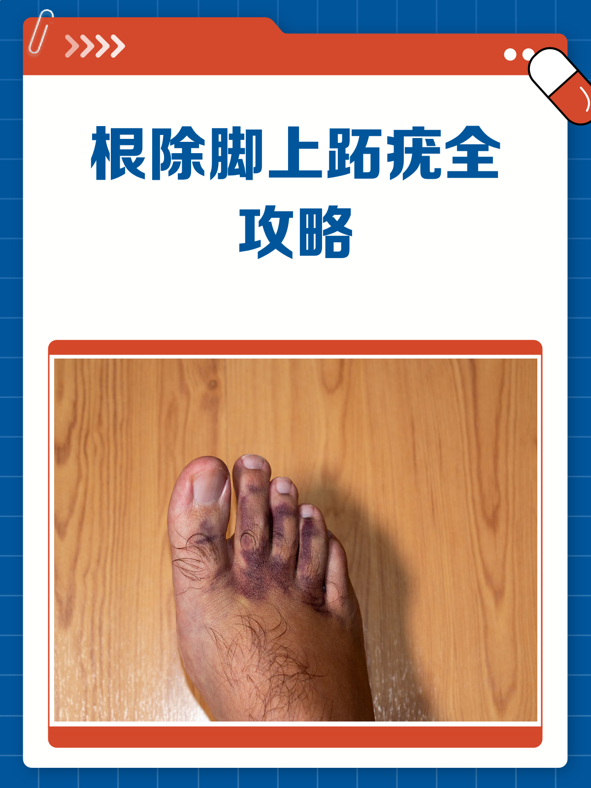 脚上跖疣,告别烦恼有妙招!