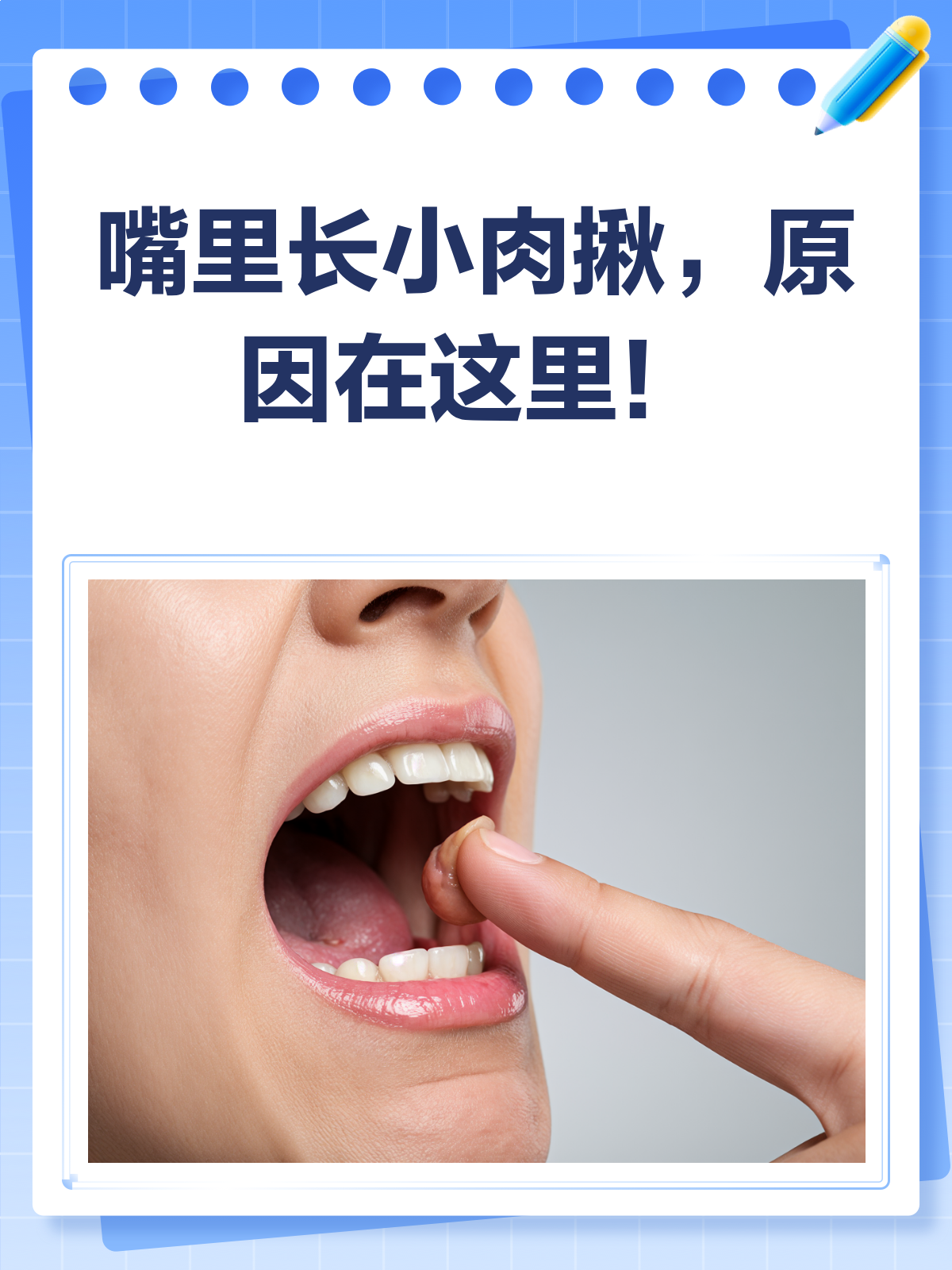 嘴里长小肉揪，别慌！先来看看这些可能原因