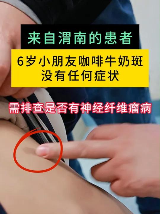 6岁小朋友咖啡牛奶斑没有任何症状