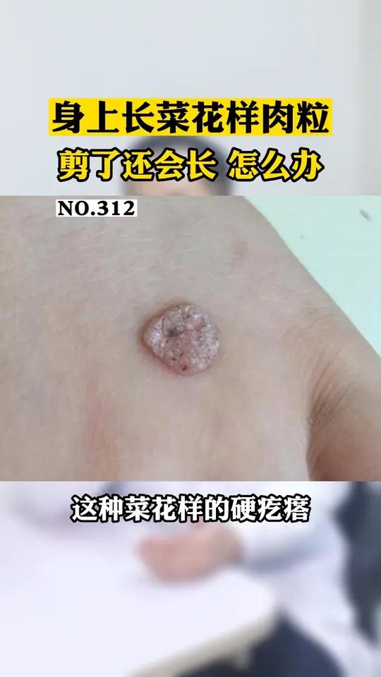 身上长这种小肉粒,叫寻常疣,民间叫瘊子。别抠!试试这样处理