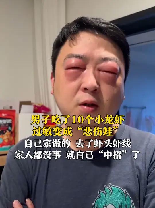 5月5日(报道),江苏常熟,男子吃了十来个小龙虾,结果过敏变成“悲伤蛙”!“自己家里做的,