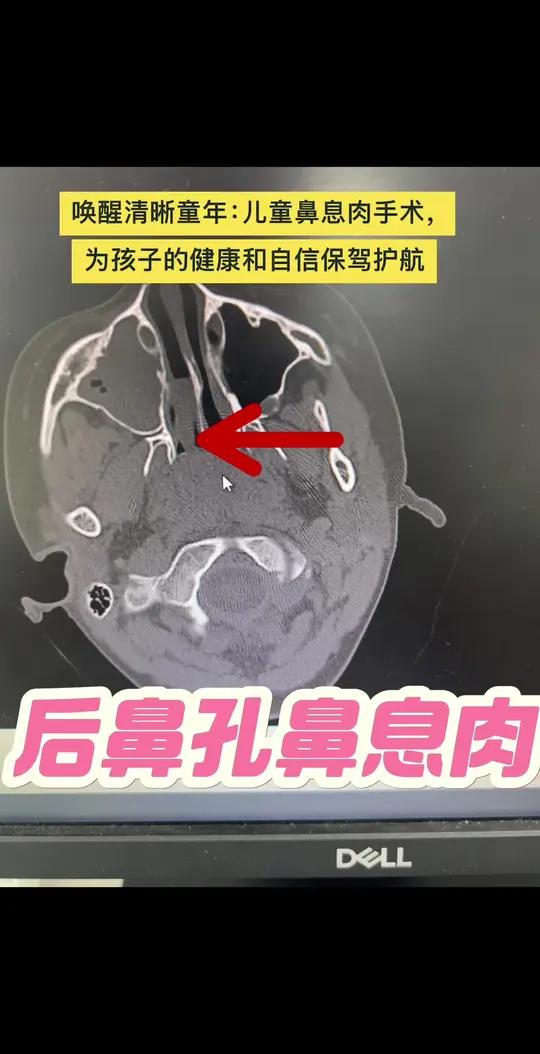 一场手术，改变呼吸：为了孩子更好的睡眠、学习和成长，唤醒清晰童年：儿童鼻息肉手术，为孩子的