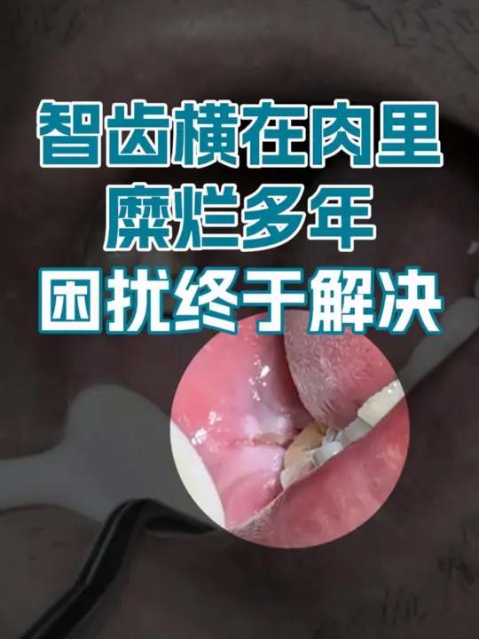阻生智齿多年不拔,发炎到溃烂,影响了整个口腔健康 拔智齿 智齿发炎 北大口腔医院 王佃灿