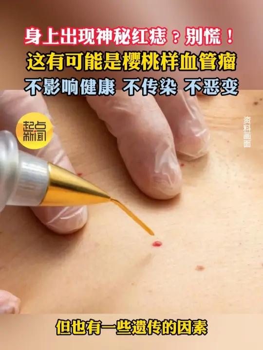 别慌!身上出现红痣可能是樱桃样血管瘤