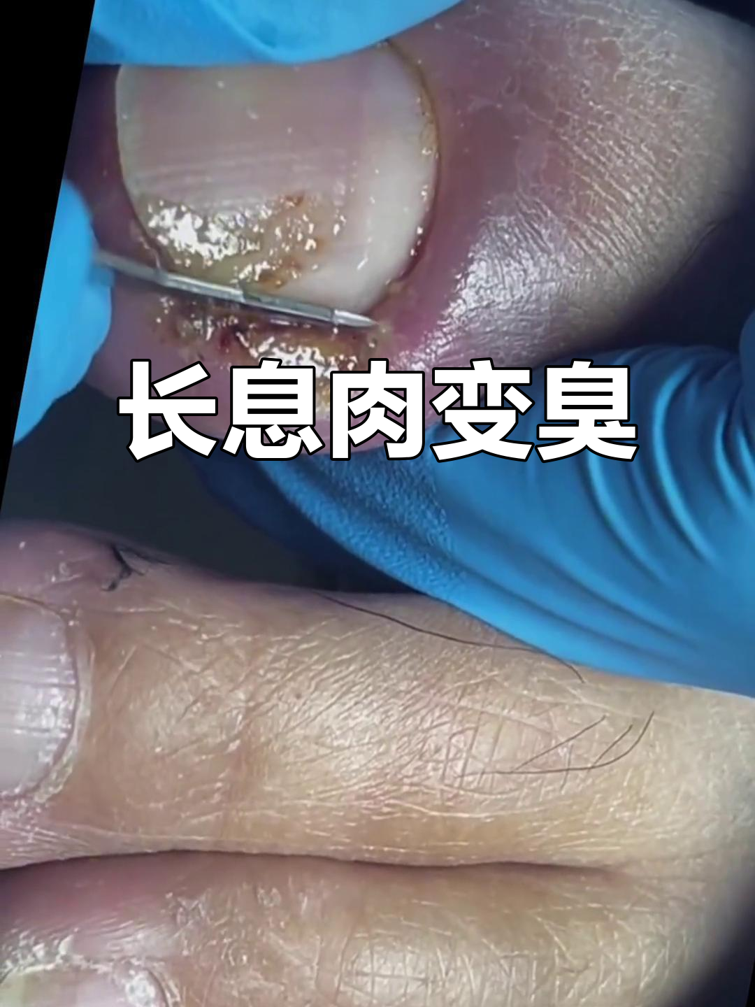 指甲长息肉,拖久了竟成大味儿!