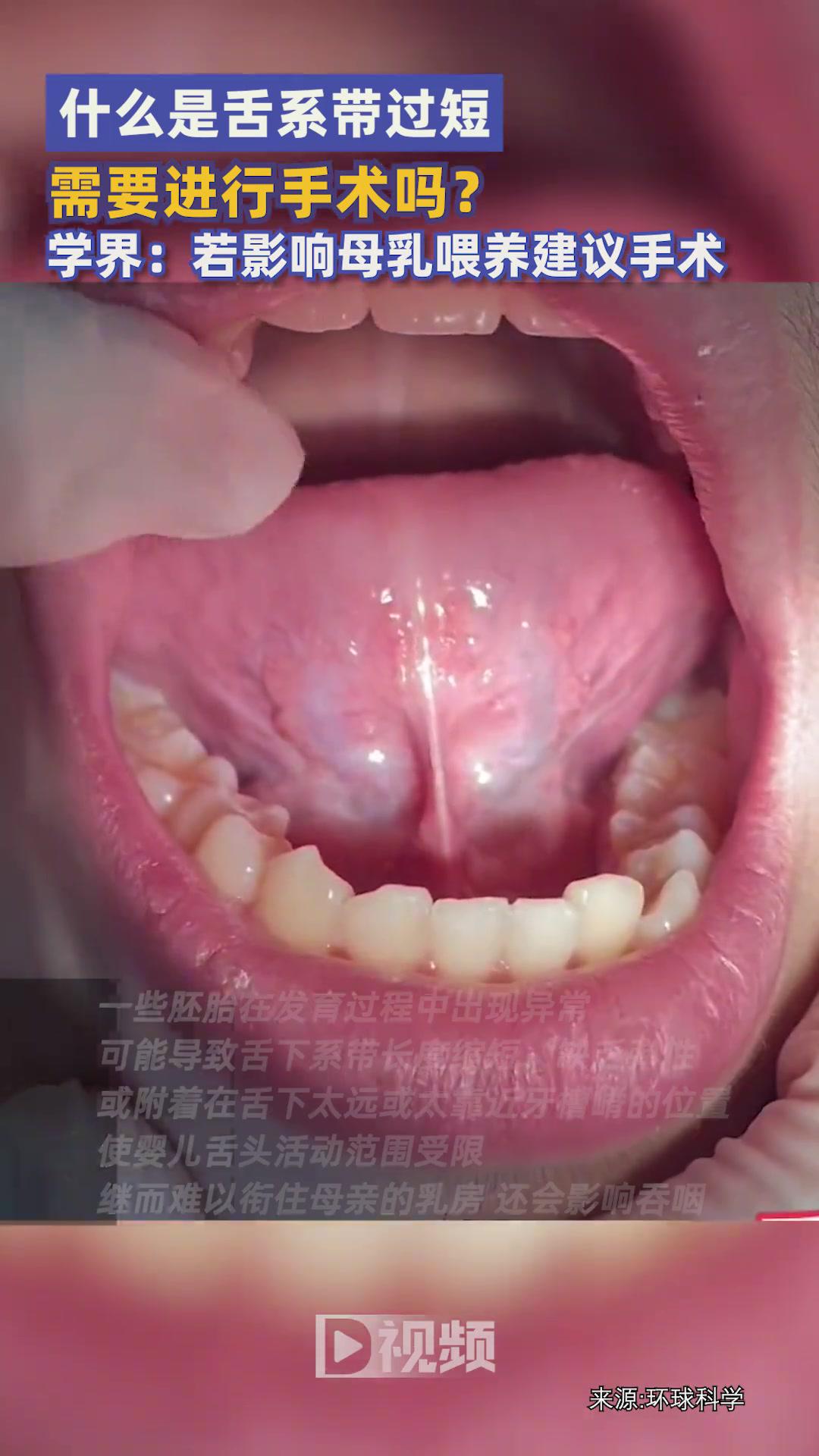 什么是舌系带过短?舌系带是我们舌头下方一条薄薄的组织,它能稳定舌根,起到辅助舌体运动的作用