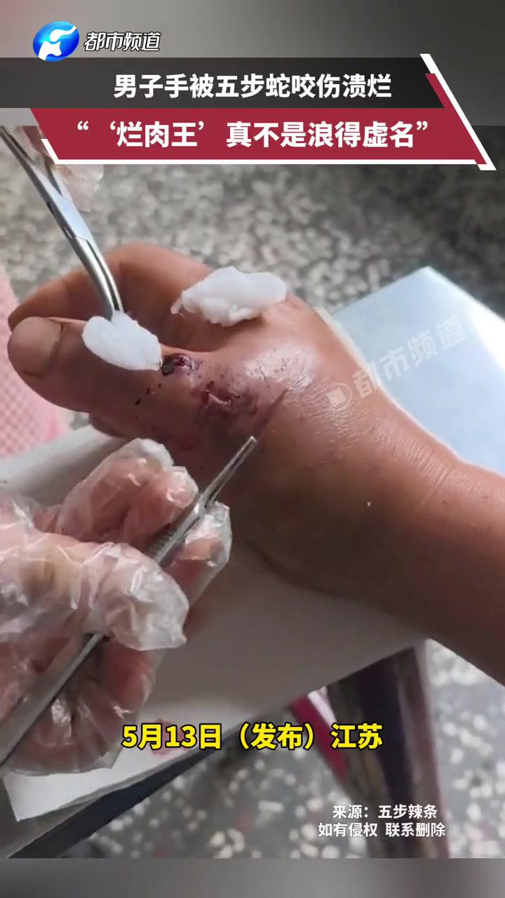 男子手被五步蛇咬伤溃烂