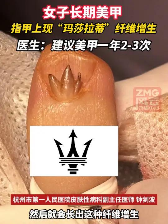 女子长期美甲,指甲上现“玛莎拉蒂”纤维增生。医生:建议美甲一年2-3次 ZMG风云传播中心