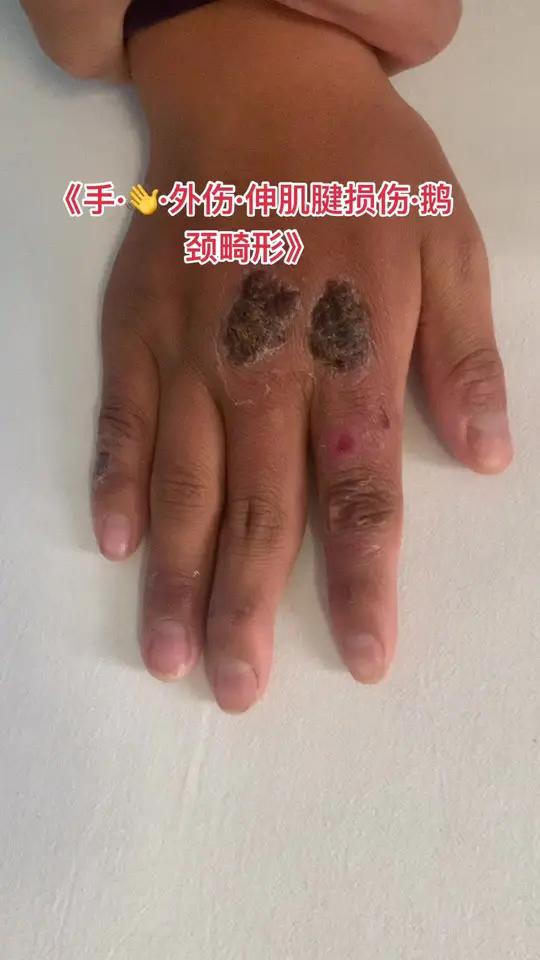 了解一下:鹅颈畸形,与手伸肌腱有关 严重的可以治疗手手指外伤手外伤手指外伤肌腱肌腱损伤鹅颈