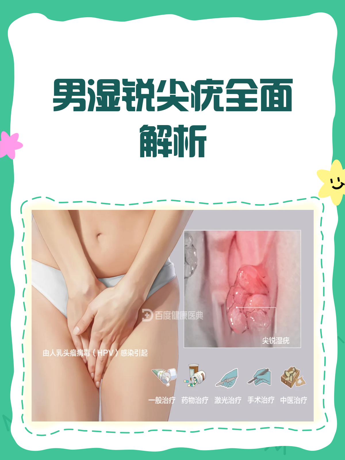男湿锐尖疣知多少?一文带你全面了解