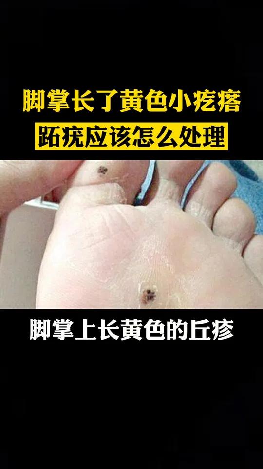 脚下长跖疣,怎么处理