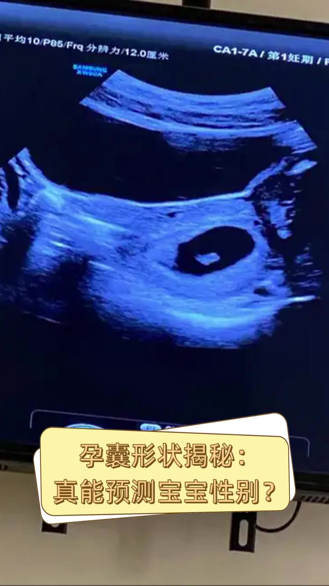 孕囊形状揭秘:真能预测宝宝性别?