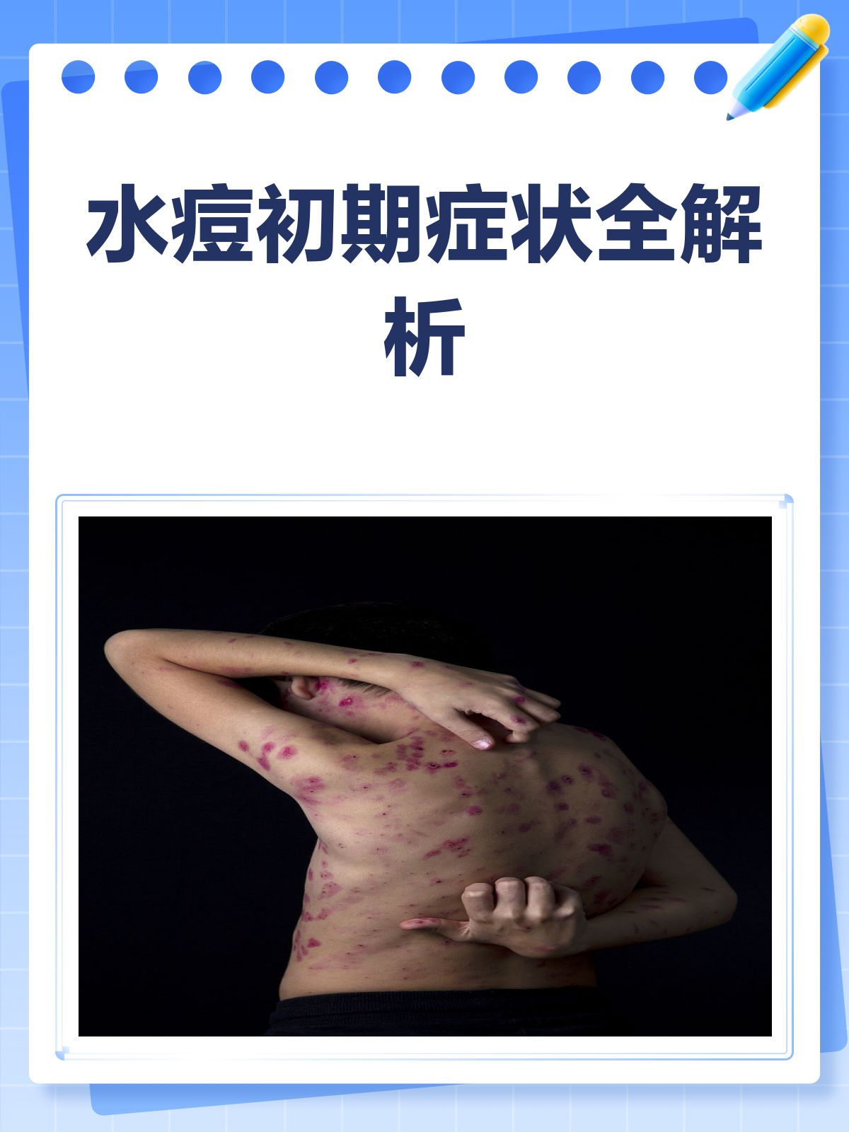 水痘初期症状大揭秘!快来看看你有没有中招!