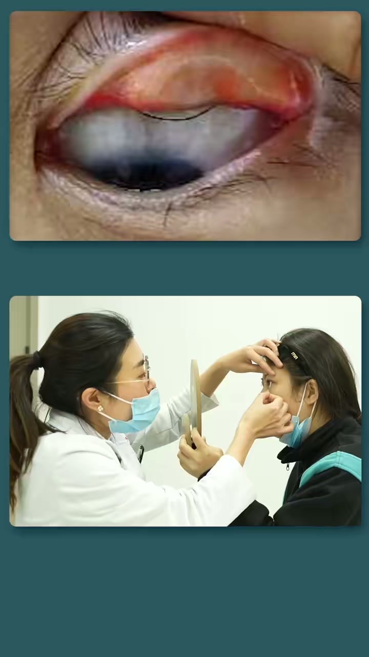 小姐姐埋线双眼皮开线，眼球磨出息肉疼得睡不着觉