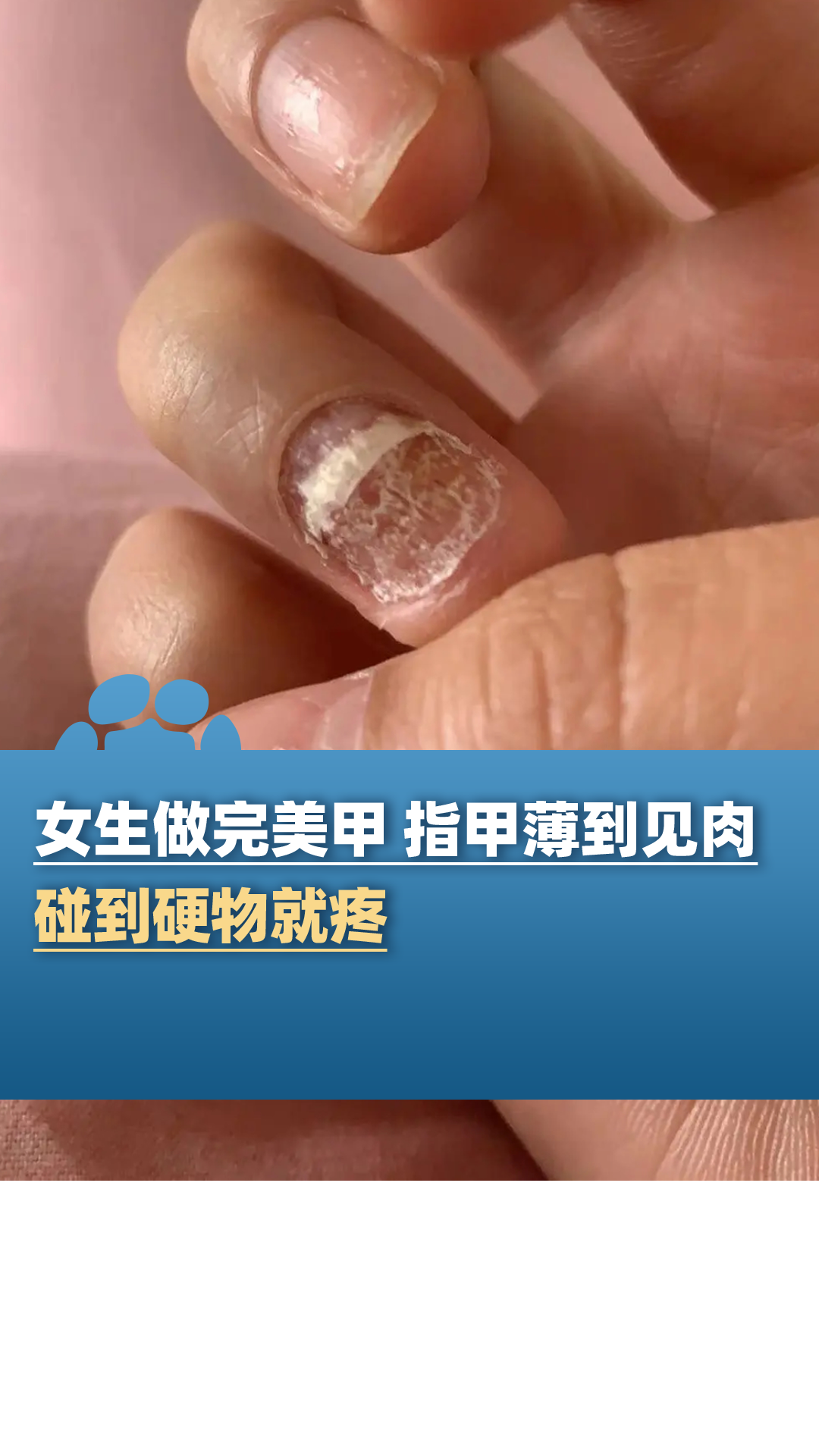 女生做完美甲后指甲薄到见肉 碰到硬物就疼还有甲沟炎的风险