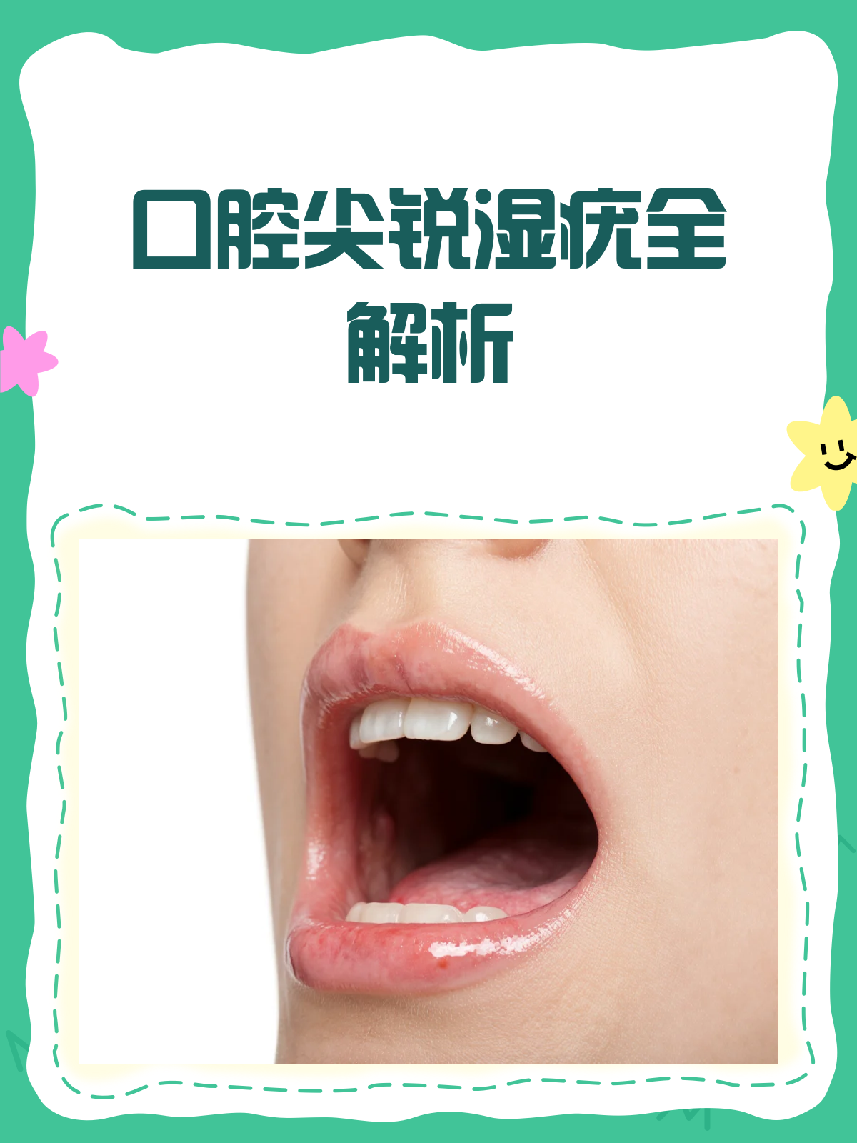 口腔也长“尖尖”?揭秘口腔尖锐湿疣!