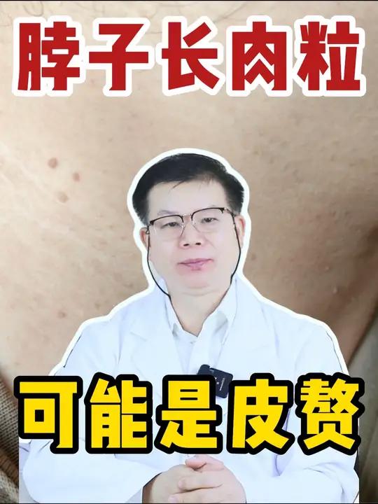 脖子上长了很多肉粒?hpv?丝状疣?别慌!这可能是皮赘。