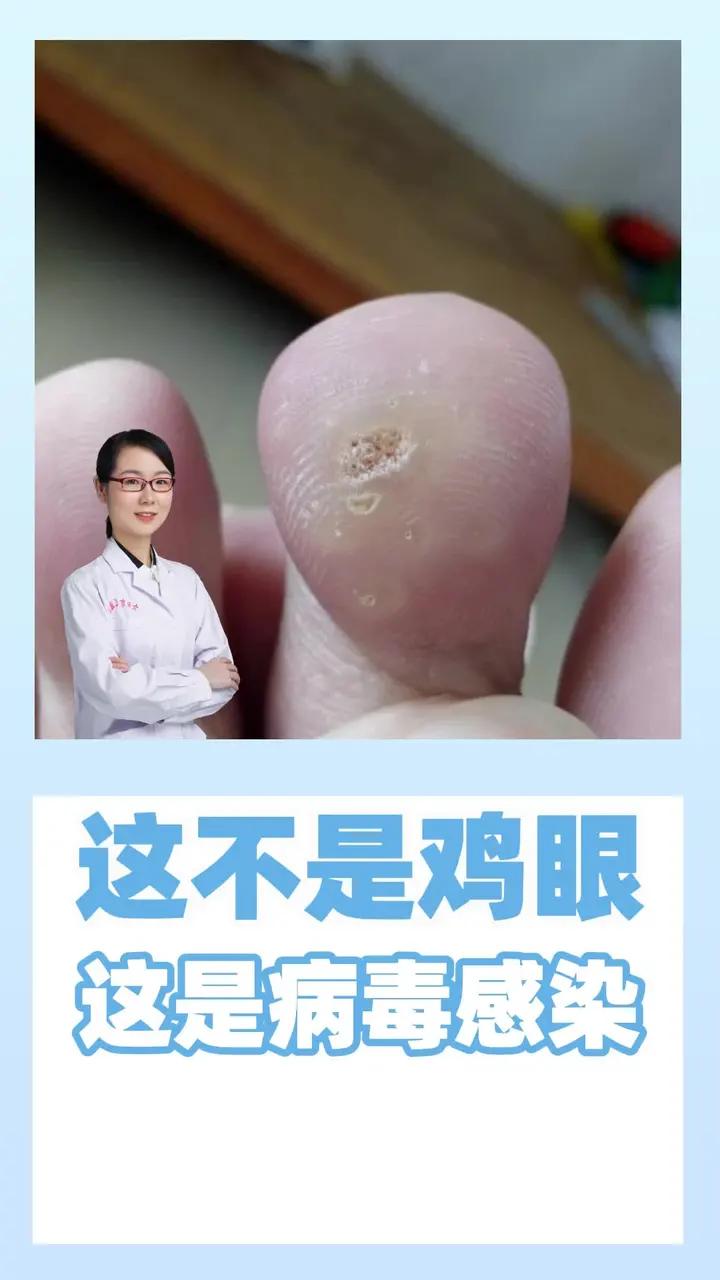 这不是鸡眼 这是病毒感染