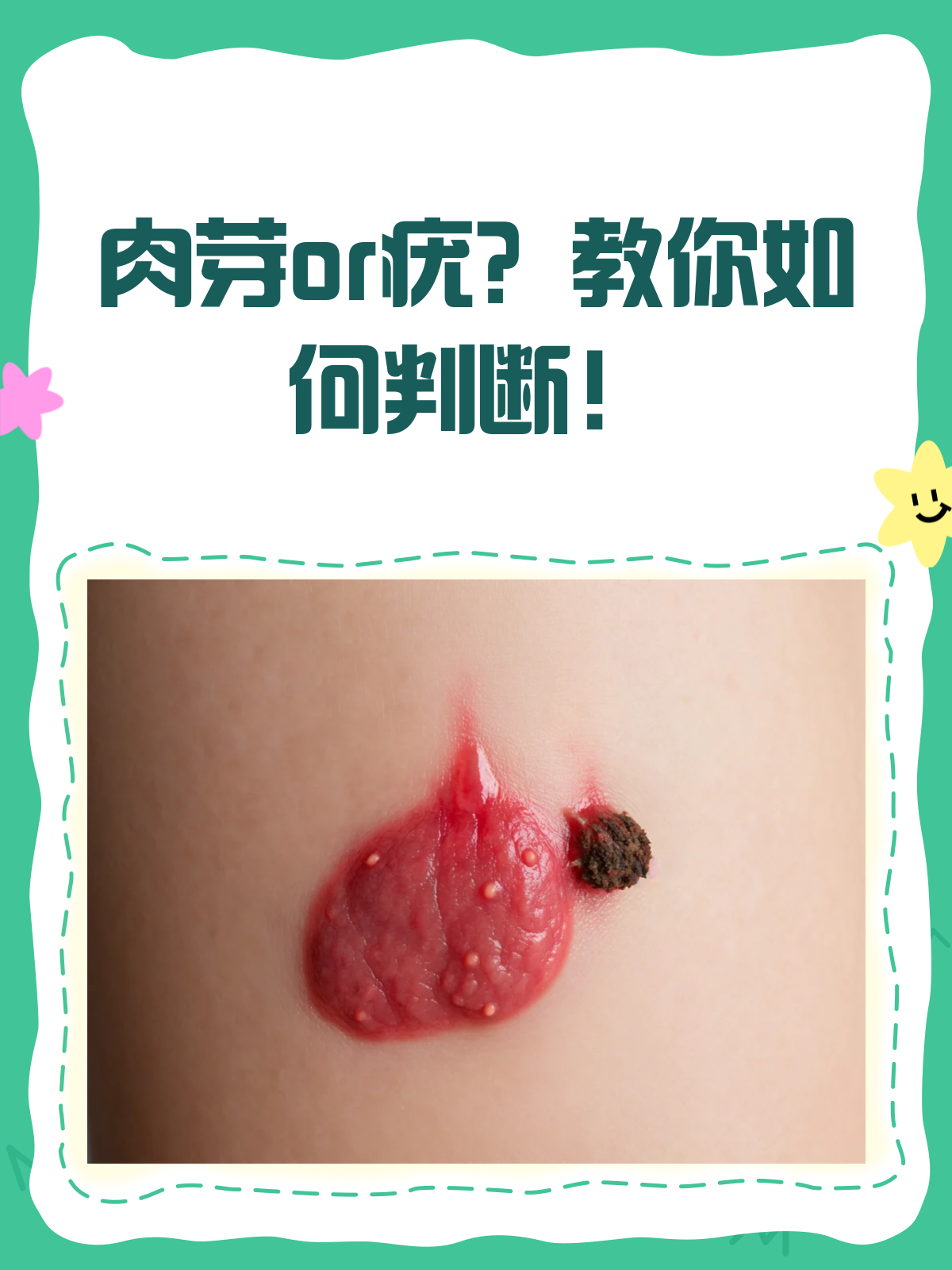 肉芽or疣?一文教你轻松辨别!