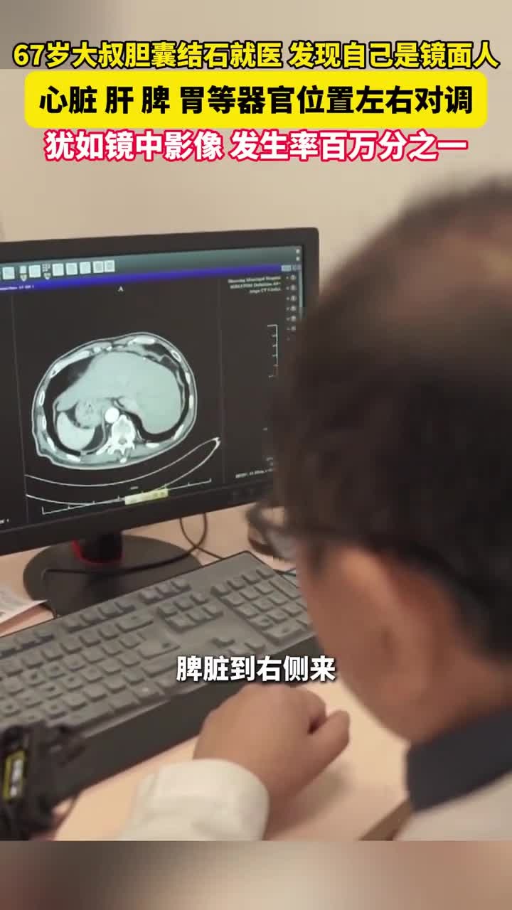 67岁大叔胆囊结石就医发现自己是镜面人,心脏、肝、脾、胃等器官位置左右对调,发生率百万分之