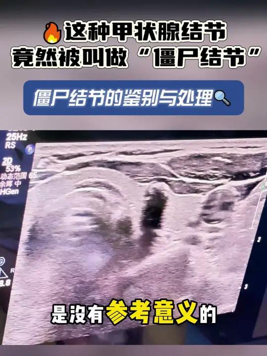这种甲状腺结节,竟然被叫做‘僵尸结节’,你知道是什么吗?