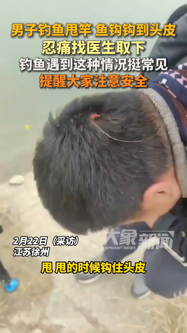男子钓鱼甩竿鱼钩钩到头皮,忍痛找医生取下